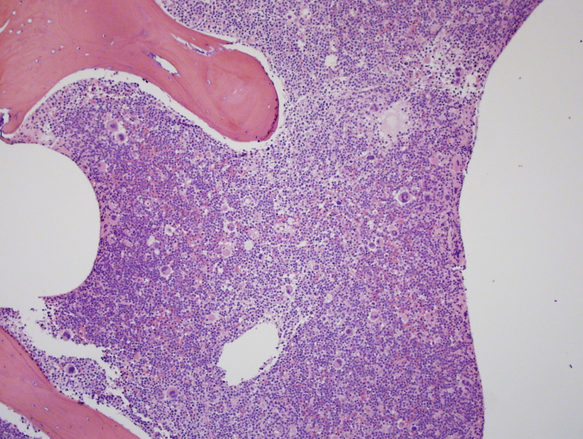 Bone Marrow Biopsy, H & E, 20X